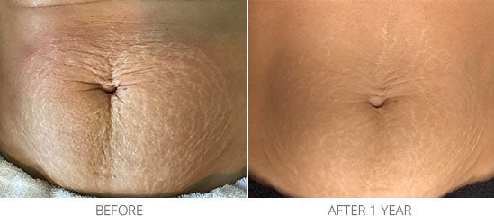 Stretch Mark Treatment Helps to Fade and Eliminate — DermaEnvy Skincare