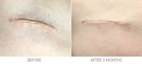 Swelling and Scar Treatment