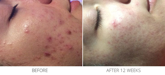 Problematic Skin/Acne Scarring