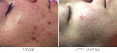 Problematic Skin/Acne Scarring