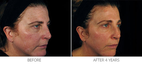 Appearance of Uneven Skin Tone, Tone, Texture & Photodamage